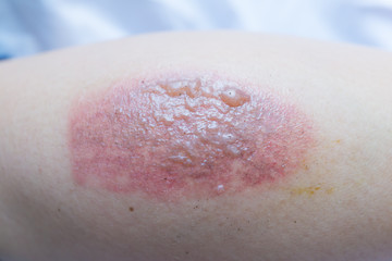 Red blisters and red blisters are caused by hot water blisters.