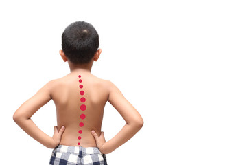 Asian kid with scoliosis, isolated on white background