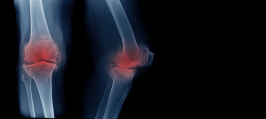 severe OA knee x-ray of old patient with copy space