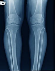 x-ray image of knee joint show mild degenerative change