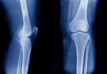 x-ray image of knee joint show mild degenerative change