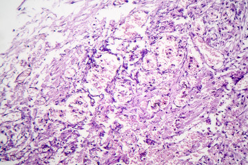 Histopathology of viral pneumonia