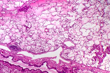 Fototapeta premium Lung adenocarcinoma
