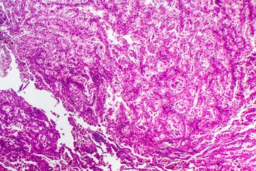 Histopathology of lung cancer