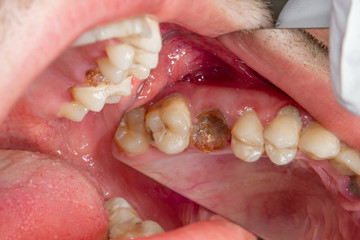 Dental caries. Filling with dental composite photopolymer material using rabbders. The concept of...