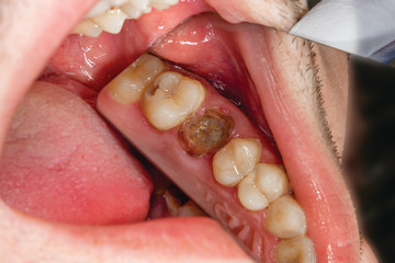 two chewing side teeth of the upper jaw after treatment of caries. Restoration of the chewing surface with a photopolymer filling material using the Rubber Dam system © Сергей Кучугурный