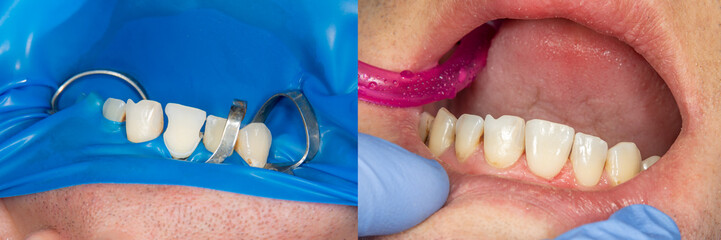 two chewing side teeth of the upper jaw after treatment of caries. Restoration of the chewing surface with a photopolymer filling material using the Rubber Dam system © Сергей Кучугурный