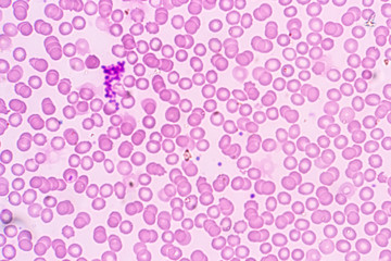 Study of white blood cells are the cells of the immune system under the microscope in laboratories.