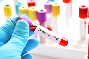 Test tube with blood sample for protein C test, coagulation disorder diagnosis