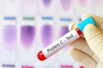 Fototapeta premium Test tube with blood sample for protein C test, coagulation disorder diagnosis
