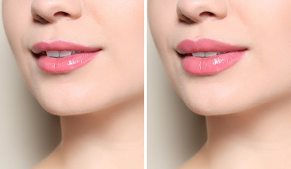 Naklejka premium Woman before and after lips augmentation procedure, closeup. Cosmetic surgery
