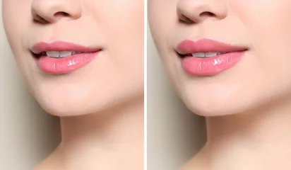 Fotobehang Woman before and after lips augmentation procedure, closeup. Cosmetic surgery © New Africa