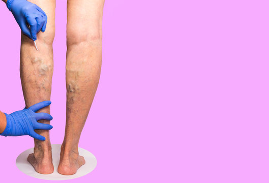 Lower limb vascular examination because suspect of venous insufficiency. The female legs on pink background