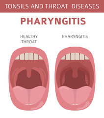 Tonsils and throat diseases. Pharyngitis symptoms, treatment icon set. Medical infographic design