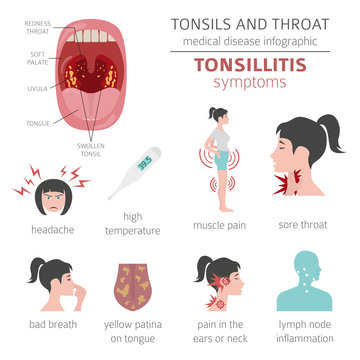 Tonsils and throat diseases. Tonsillitis symptoms, treatment icon set. Medical infographic design