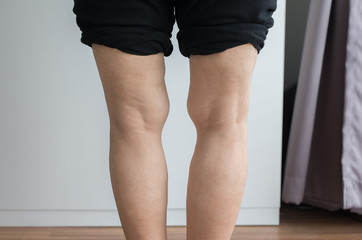 Elderly woman leg bandy-legged shape of the body
