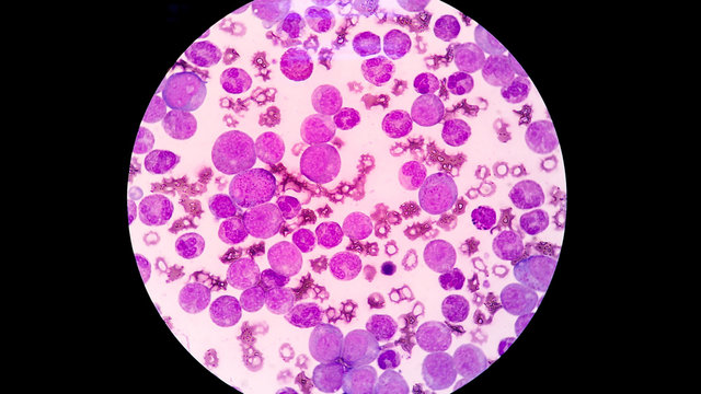 Blood human abnormal cell (Blast cell) 