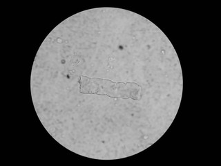 Significance Cast of Urinary under 40X light microscope, Waxy cast