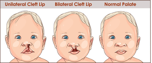 illustration of a cleft palate in a child. plastic surgery. reconstruction of the upper palate