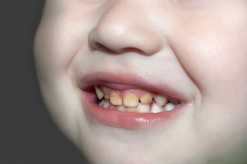 The boy’s broad smile demonstrates improper oral and dental care.