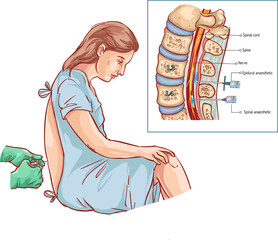 Epidural Nerve Block Injection