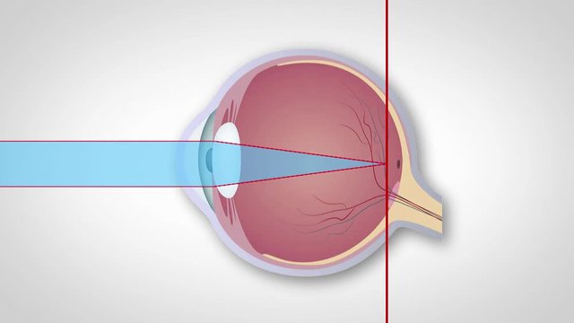 Schematic representation of hyperopia, myopia and astigmatism, Correction of various eye vision disorders by lens. Hyperopia, myopia and astigmatism,