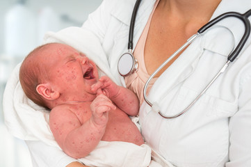 Doctor holding a newborn baby which is sick rubella or measles - obrazy, fototapety, plakaty