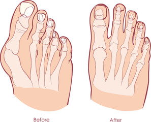 Human foot deformity. Hallux Valgus and tailors bunion. - obrazy, fototapety, plakaty