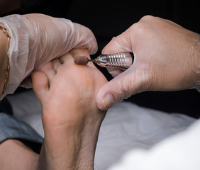 Close up of Calluses. Painful corn on foot. Treatment of corns on the feet.
