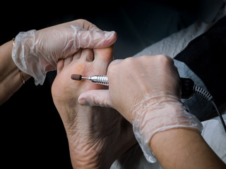Close up of Calluses. Painful corn on foot. Treatment of corns on the feet.   © sablinstanislav