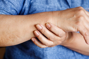 Fototapeta premium Hands of an elderly woman with arthritis closeup