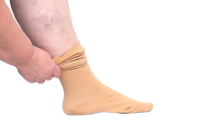 Woman putting on the leg medical stocking for varicose veins on the legs, white background,...