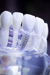 Dentist dental teeth implant