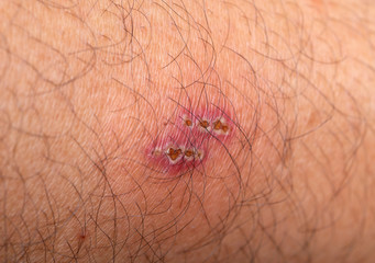 Wound infection on the skin, Skin lesions, Impetigo, Ecthyma