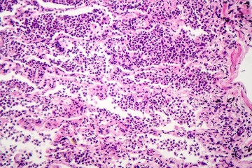 Histopathology of interstitial pneumonia