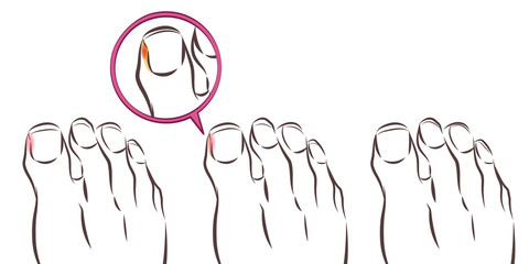 healthy foot and ingrown nail