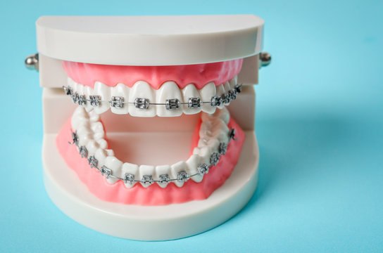 tooth model with metal wire dental braces.