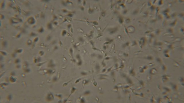 Sperm (spermatozoa) viewed under the microscope. Moving human sperm under Phase contrast Microscope. Close up showing spermatozoons. Video semen under microscope. 4K UHD