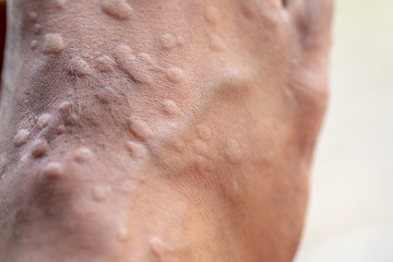 Naklejka premium The lesion on foot after caused by ants bites (Red imported fire ant).