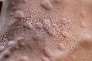 Fototapeta premium The lesion on foot after caused by ants bites (Red imported fire ant).