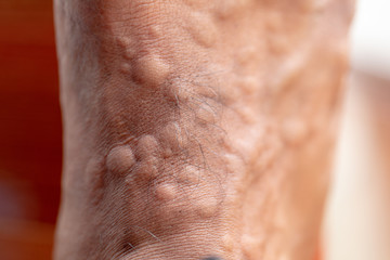 Naklejka premium The lesion on foot after caused by ants bites (Red imported fire ant).