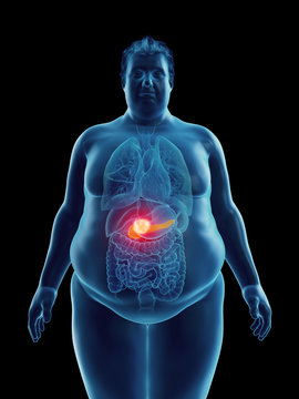 3d rendered medically accurate illustration of an obese mans pancreas tumor