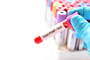 Blood sample tube for total P1NP test, diagnosis for bone disease
