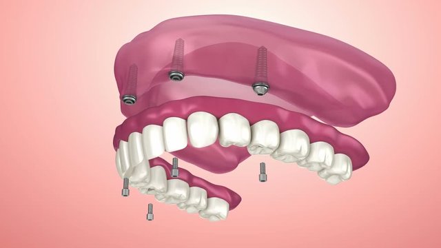 Overdenture to be seated on implants - ball attachments, instalation process. 3D animation