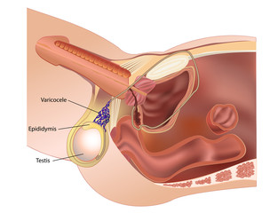 Varicocele in testicular vessels