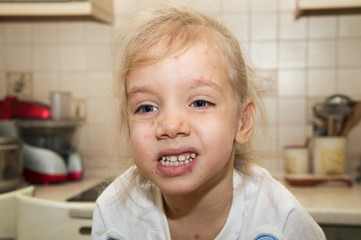 Close up. The girl fell ill with chickenpox. The face is littered with chickenpox, pimples,...