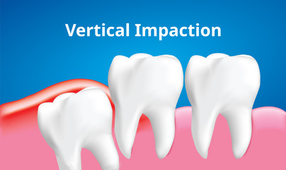 Wisdom tooth ( Vertical impaction ) with inflammation affect , Dental care concept, Realistic illustration Vector