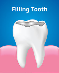 Tooth Filling with gum Dental care concept, Realistic design illustration Vector.