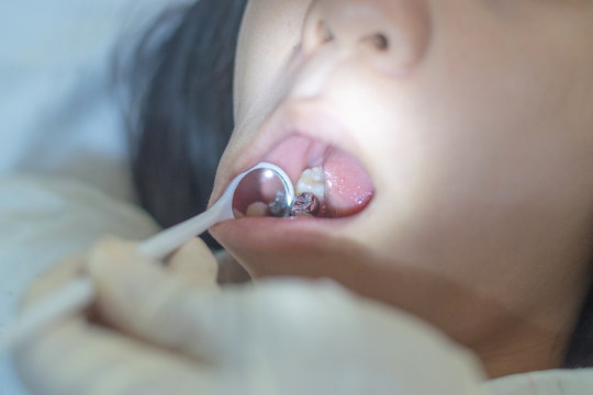 Silver amalgam crown dental filling in mouth with dentist' hands using mirror and equipment to do teeth cleaning . Asia girl child with tooth sealant