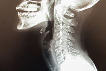 Normal cervical spine of a girl, X-ray Cervical spine after had an adcident.